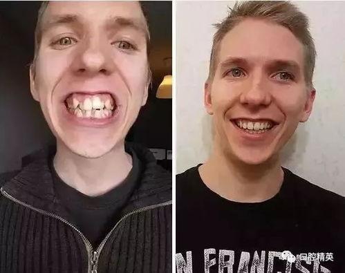 娱乐圈爆料卡通牙套,卡通牙套引领娱乐圈新潮流